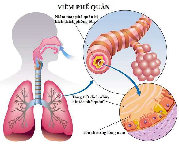 bệnh viêm phế quản