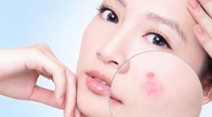 bệnh nóng trong người