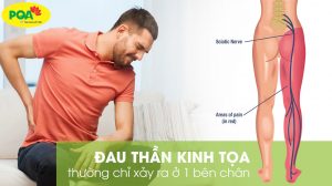 đau thần kinh tọa