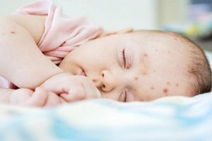 trẻ bị nóng trong người